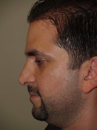 Before and After Revision Rhinoplasty 671587