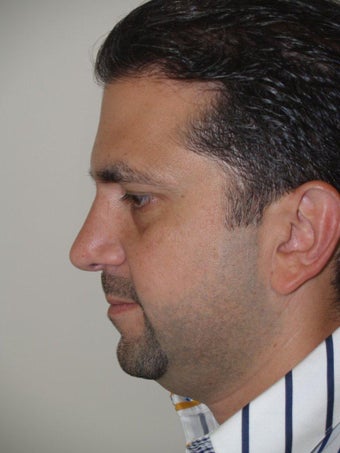 Before and After Revision Rhinoplasty 671587