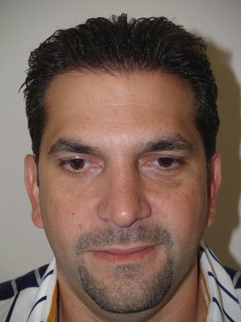 Before and After Revision Rhinoplasty after 671587