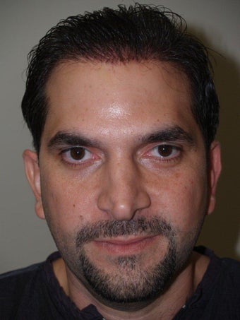 Before and After Revision Rhinoplasty before 671587