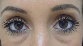 Restylane Under Eyes before 1285435