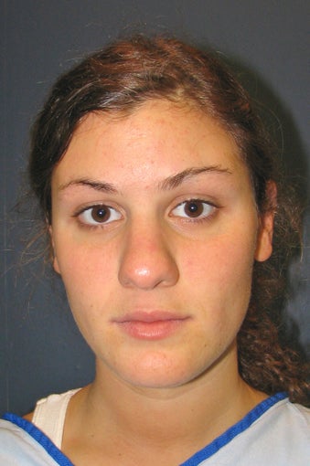 Nose Surgery before 925581