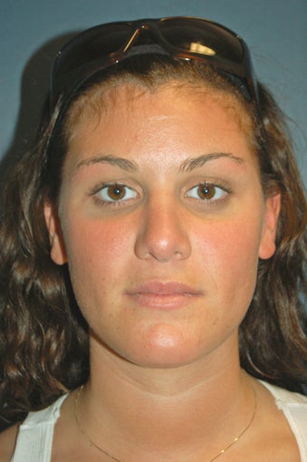 Nose Surgery after 925581