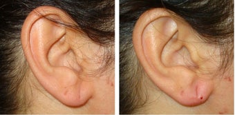 40 Year Old Female Treated for Ear Lobe Laxity before 1367297
