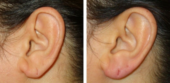 40 Year Old Female Treated for Ear Lobe Laxity after 1367297
