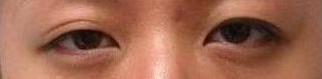 Bilateral Asian Eyelid Surgery before 861145
