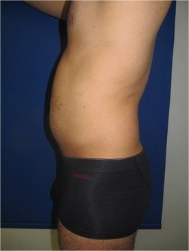 Laser Lipo 333257