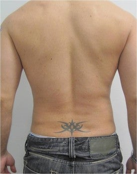 Laser Lipo after 333257