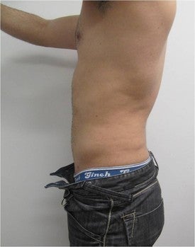 Laser Lipo 333257