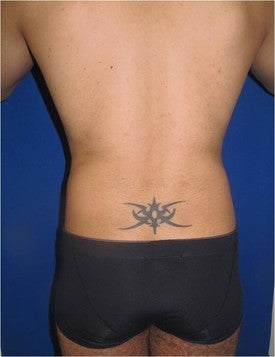Laser Lipo before 333257
