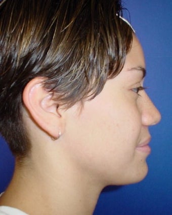 Septorhinoplasty 756137