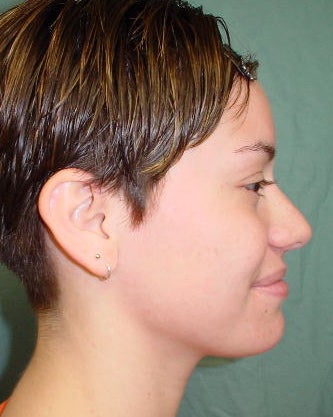Septorhinoplasty 756137