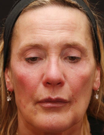 Fraxel Repair for Sun Damage and Wrinkles before 110208