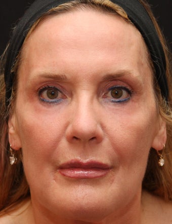 Fraxel Repair for Sun Damage and Wrinkles after 110208