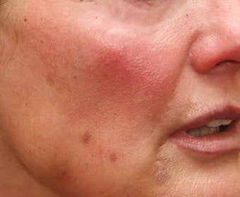 Fraxel Repair for Sun Damage and Wrinkles 110208