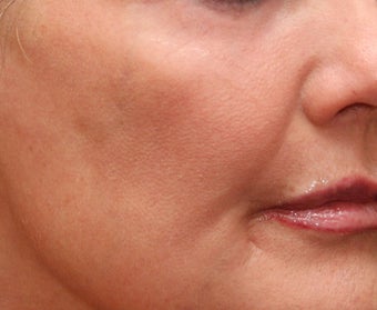 Fraxel Repair for Sun Damage and Wrinkles 110208