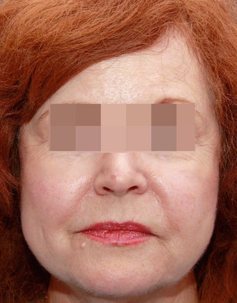 Sculptra for Volume Loss after 219229