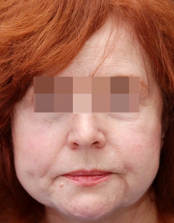 Sculptra for Volume Loss before 219229