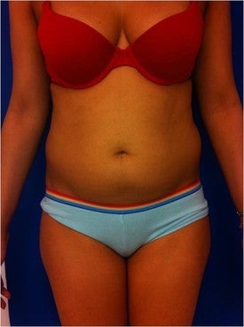 Laser Liposuction 561231