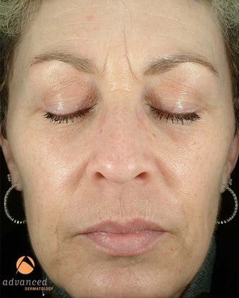 Female Treated with BOTOX® Cosmetic and Restylane® before 1047006