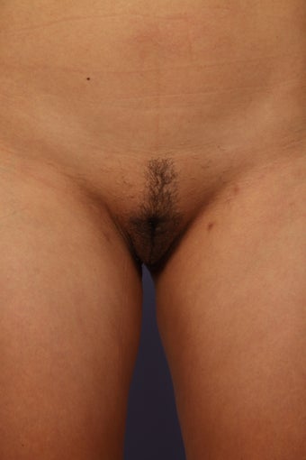Labiaplasty after 692940