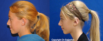 Ear Surgery before 1245302