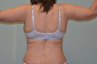 arm lift 1060308