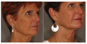 Luminous Lift after 874457