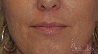 49 y/o female desired fuller lips with filler. before 1137137