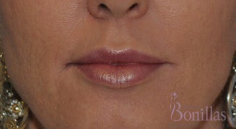 49 y/o female desired fuller lips with filler. after 1137137