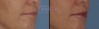 49 y/o female desired fuller lips with filler. 1137137