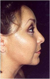 Endoscopic Facelift after 205401