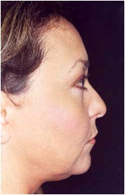 Endoscopic Facelift before 205401