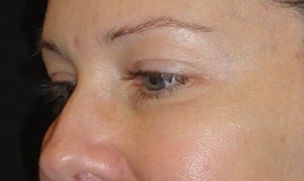 Restylane after 959475
