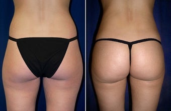 Liposuction before 997115