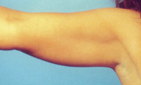 Arm Liposuction before 652130