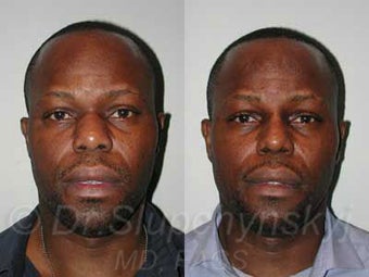 32 year old African American Male - Rhinoplasty 987246