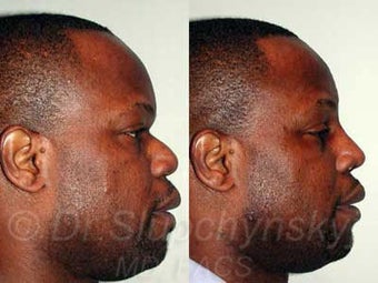 32 year old African American Male - Rhinoplasty after 987246