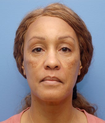 Facial Dermafillers before 1046897