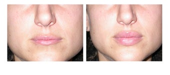 Lip Augmentation before 91872