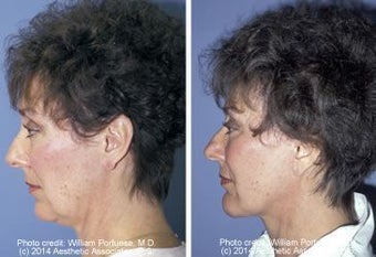 Neck Lift before 91342