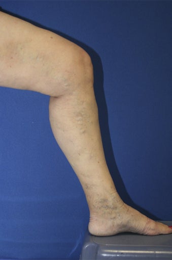 vnus ablation after 297052