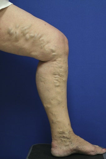 vnus ablation before 297052