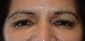 45 Year Old Female Treated For Glabellar Lines after 1373420