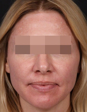 Filler for Under-Eye Hollows 539863