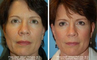 Facelift before 91478