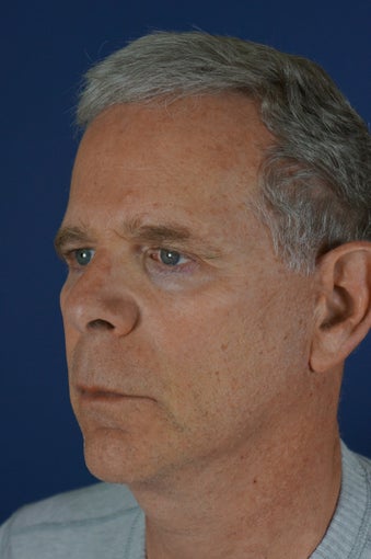 60 year male with liquid facelift 923514