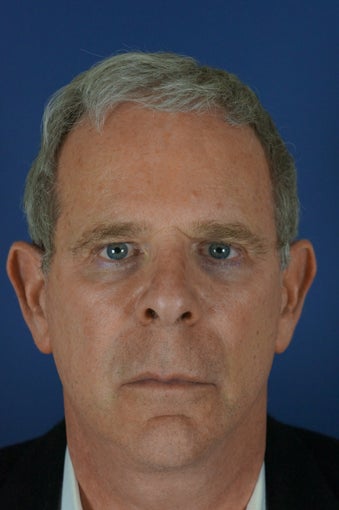 60 year male with liquid facelift after 923514