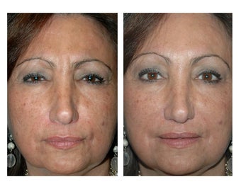 Botox for Frown Lines before 896477