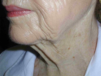 85 year old necklift before 652594